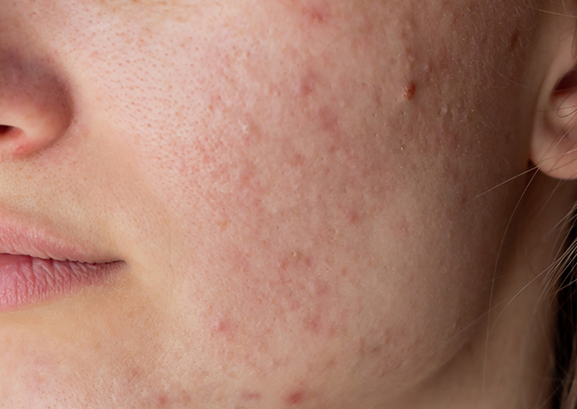 Facial skin showing visible pores and uneven texture before dermatological treatment