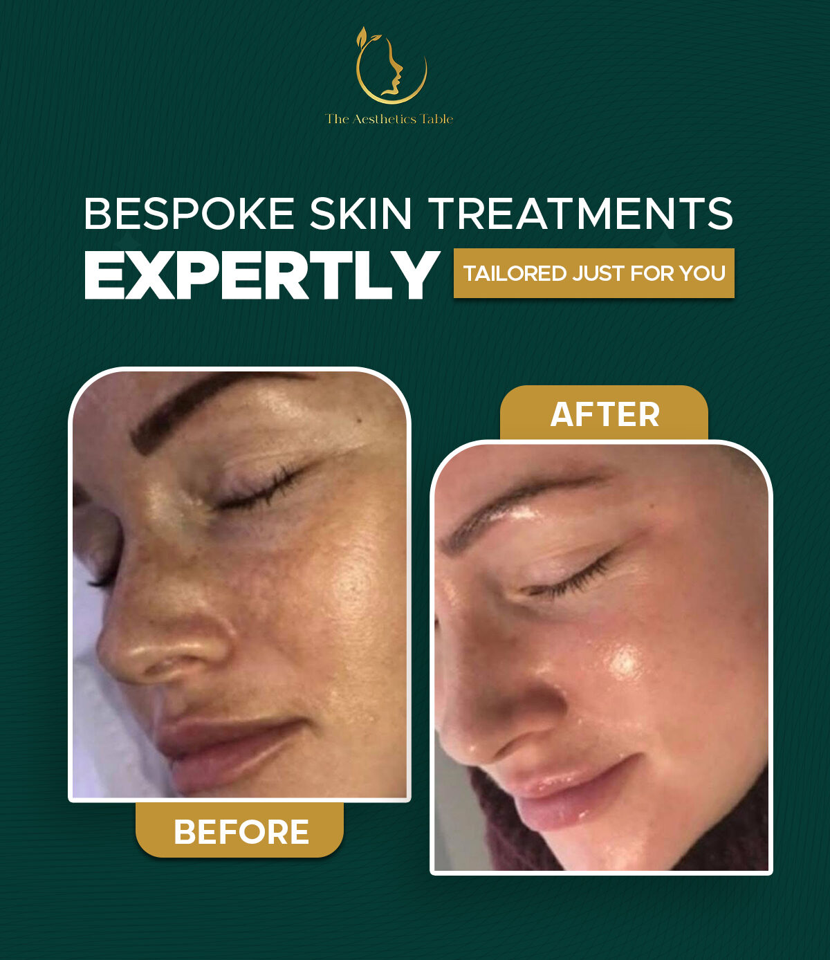 Before and after results of pH Formula treatment for redness-prone facial skin