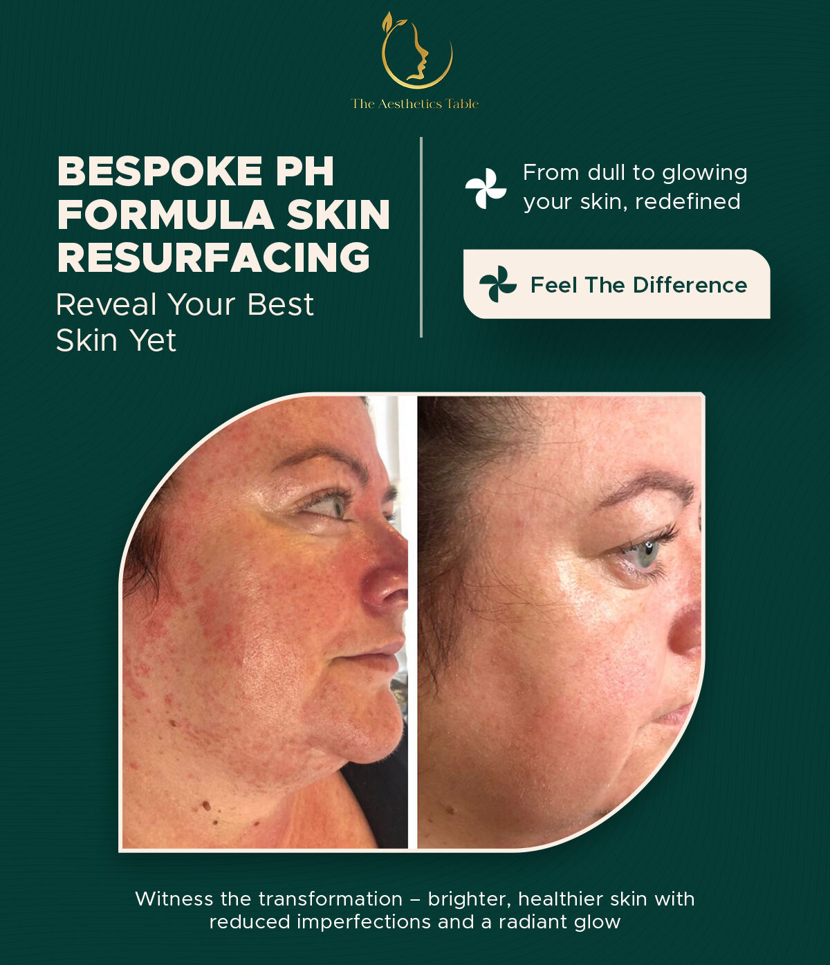 Before and after bespoke pH Formula skin resurfacing showing calmer, more even facial skin tone
