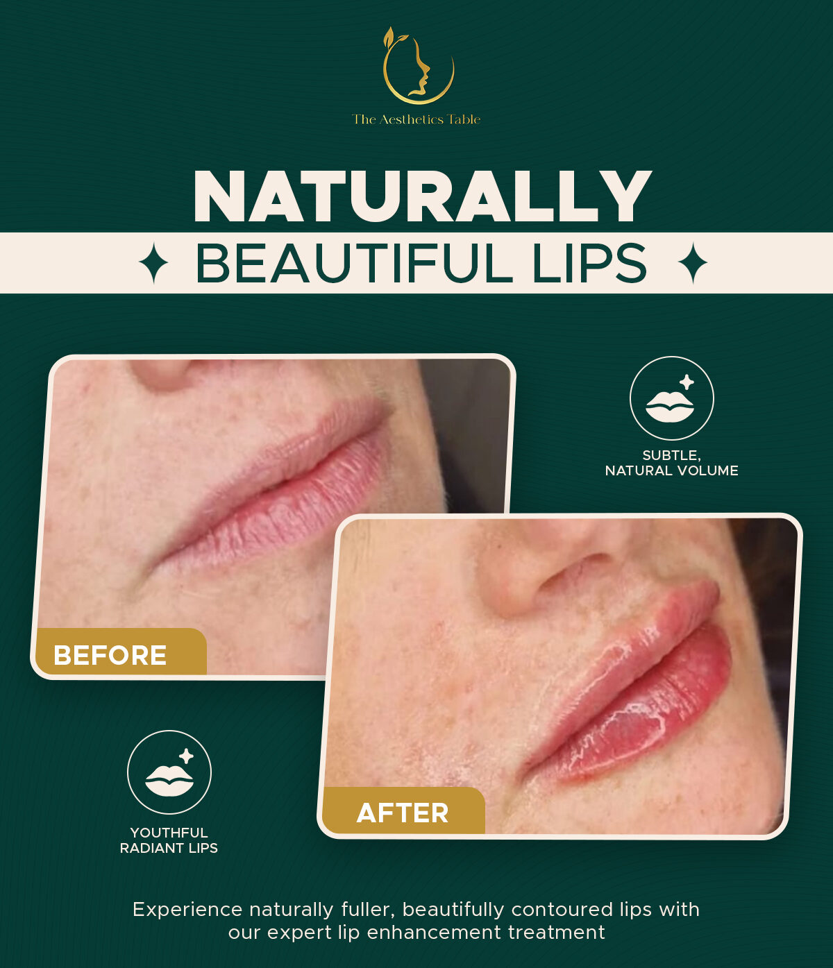 Naturally Beautiful Lips Treatment-The Aesthetics Table